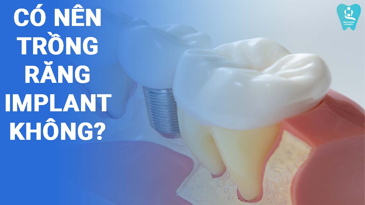 có nên trồng răng implant không