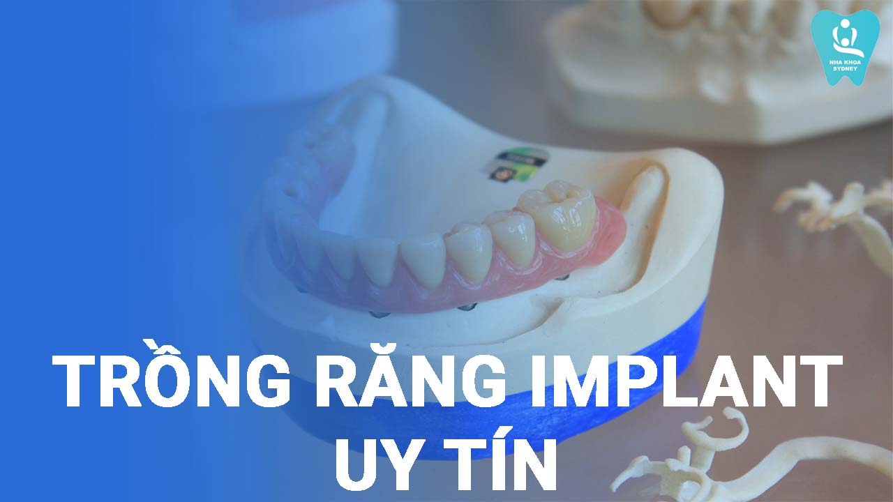 trồng răng implant uy tín